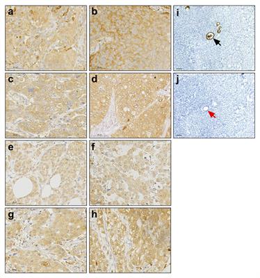 A tumor cell specific Zona Pellucida glycoprotein 3 RNA transcript encodes an intracellular cancer antigen